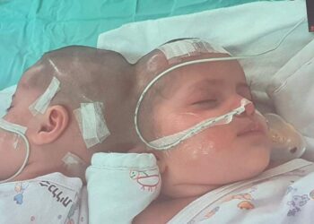 Separan con éxito a siamesas unidas por la cabeza.