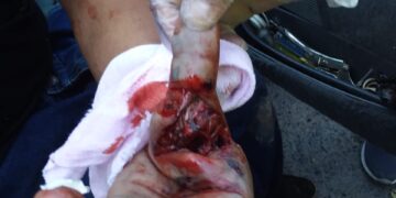 Mortero le destroza la mano a salvadoreño.