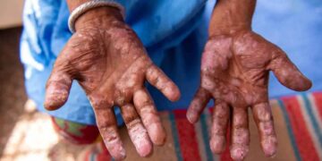 México emite alerta sanitaria por casos de lepra.